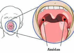 Không nên lạm dụng kháng sinh khi viêm amiđan