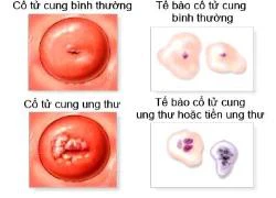 Một phương pháp đơn giản sàng lọc ung thư cổ tử cung