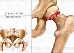 Thuốc chống loãng xương gây hại xương