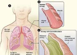 Ai dễ mắc bệnh giãn phế quản?