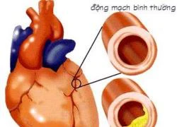 Cảnh giác với biến chứng tim mạch ở người bệnh tiểu đường