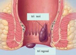 Tác hại của bệnh trĩ