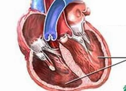 Nhận biết sớm suy tim, ngừa đột quỵ