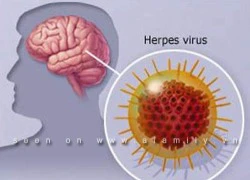 Coi chừng: Lao màng não dễ nhầm với viêm não