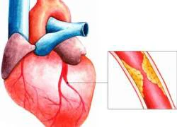 Phòng nhồi máu cơ tim do tăng cholesterol