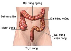 Pôlýp đại - trực tràng - Dấu hiệu ung thư