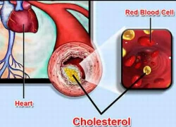 Liên quan rối loạn mỡ máu và bệnh tim mạch