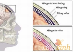 Lựa chọn kháng sinh điều trị bệnh viêm não