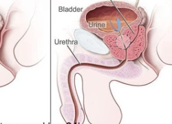 Cảnh báo về thuốc finasterid chữa phì đại lành tính tiền liệt tuyến