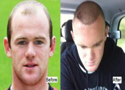 Wayne Rooney "bất lực" vì thuốc trị rụng tóc?