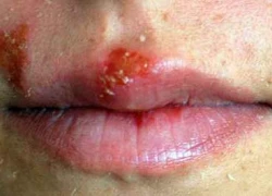 Herpes là bệnh gì?