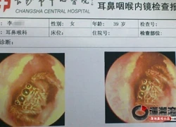 Nhện sống trong tai người suốt 5 ngày