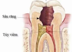 Phục hồi thân răng sau điều trị