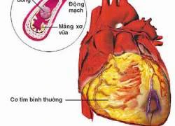 Sôđa tăng nguy cơ mắc bệnh về tim mạch