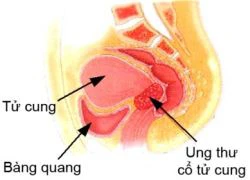 Ung thư cổ tử cung: Y học bó tay nếu chữa muộn