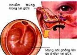 Viêm tai giữa tiết dịch - bệnh hay gặp ở trẻ