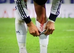 Ronaldo bị chảy máu, Real lo sốt vó