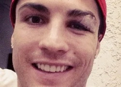 Mắt đau, Ronaldo vẫn cố "tự sướng" trên Facebook