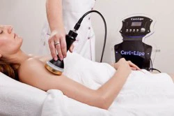 Giảm mỡ ưu đãi 15% với Cavi-Lipo