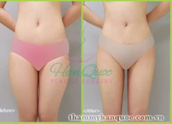 Hút mỡ bụng an toàn bằng máy Laser Lipo