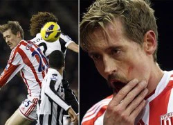 Peter Crouch bị gãy ba chiếc răng