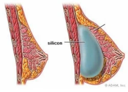 Chọn túi ngực phù hợp