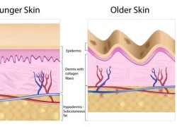 Nâng cơ, săn chắc da mặt FractoraFrim