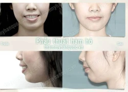 Phẫu thuật hàm hô không cần niềng răng