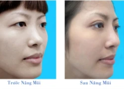 Nâng mũi Hàn Quốc S-line