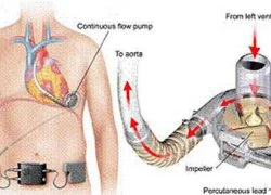 Kỳ lạ, thiếu nữ sống nhờ trái tim để trong túi xách