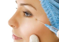 Botox xóa vết chân chim ra sao