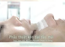 Nâng mũi S line với TS.BS.Man Koon Suh