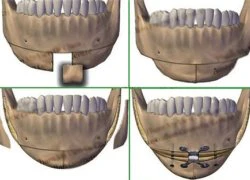 Phẫu thuật gọt hàm: Phức tạp và đau đớn