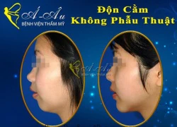 Nâng mũi, độn cằm không phẫu thuật