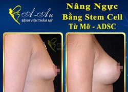 Nâng ngực, độn mông không dùng túi bằng Stem Cell