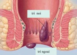 "Nhận diện" bệnh trĩ