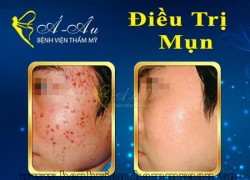 Trị mụn hiệu quả không để lại sẹo