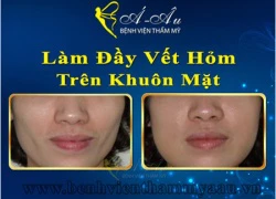 Căng da, làm đầy vết hõm trên khuôn mặt