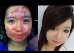 Cô gái trẻ mặt đầy mụn trứng cá biến thành hotgirl nhờ make up