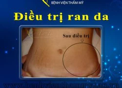 Điều trị rạn da - Đừng để quá muộn