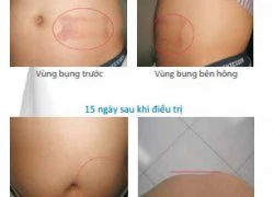 Giảm béo hiệu quả bằng công nghệ mới Cryolipolysis