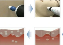 Micro Needle Therapy tái tạo da sẹo