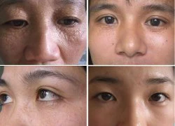 Trị mụn thịt vĩnh viễn với Laser CO2 Fractional