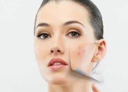 Trị sẹo lõm bằng laser thế hệ mới