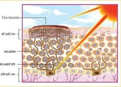Trị tàn nhang tận gốc chỉ 1 lần duy nhất