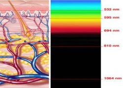 Triệt lông vĩnh viễn với công nghệ mới X-LASE