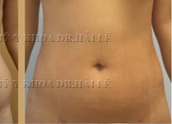 Tư vấn hút mỡ không phẫu thuật Cavi-Lipo