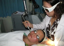 Đặc trị nám bằng công nghệ Spectra Laser