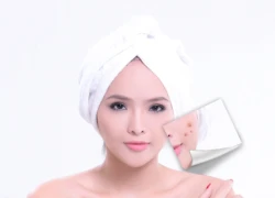 Duet RF trị sẹo lõm nhanh chóng, triệt để