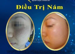 Thay da vi thể, xóa nám, sẹo rỗ 1 lần duy nhất